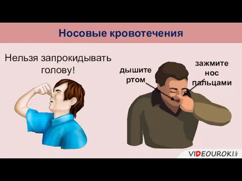 Носовые кровотечения Нельзя запрокидывать голову! дышите ртом зажмите нос пальцами