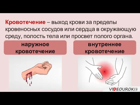 Кровотечение – выход крови за пределы кровеносных сосудов или сердца в окружающую