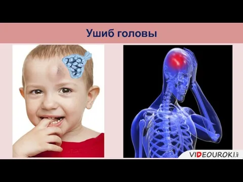 Ушиб головы