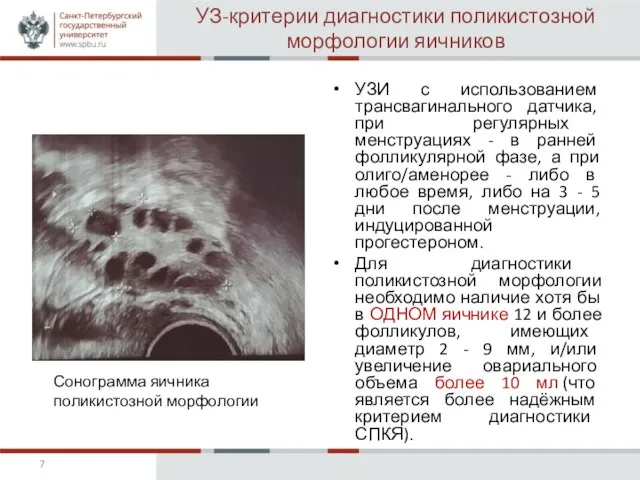 УЗ-критерии диагностики поликистозной морфологии яичников УЗИ с использованием трансвагинального датчика, при регулярных