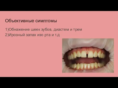 Объективные симптомы 1)Обнажение шеек зубов, диастем и трем 2)Ирозный запах изо рта и т.д