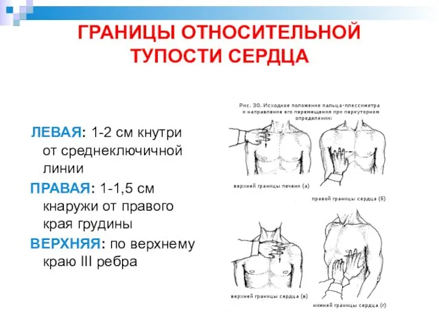 ГРАНИЦЫ ОТНОСИТЕЛЬНОЙ ТУПОСТИ СЕРДЦА ЛЕВАЯ: 1-2 см кнутри от среднеключичной линии ПРАВАЯ: