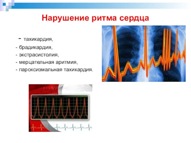 Нарушение ритма сердца - тахикардия, - брадикардия, - экстрасистолия, - мерцательная аритмия, - пароксизмальная тахикардия.