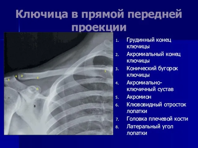 Ключица в прямой передней проекции Грудинный конец ключицы Акромиальный конец ключицы Конический