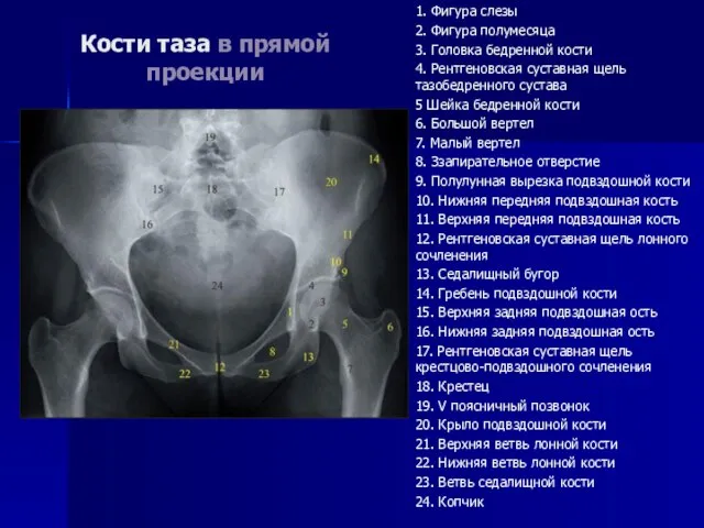 Кости таза в прямой проекции 1. Фигура слезы 2. Фигура полумесяца 3.