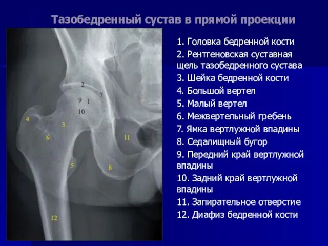 Тазобедренный сустав в прямой проекции 1. Головка бедренной кости 2. Рентгеновская суставная