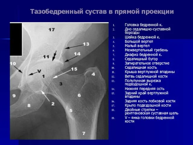 Тазобедренный сустав в прямой проекции Головка бедренной к. Дно седалищно-суставной борозды Шейка