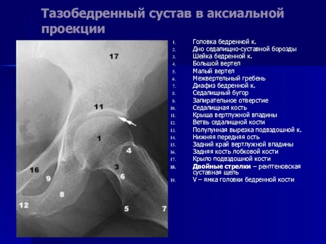 Тазобедренный сустав в аксиальной проекции Головка бедренной к. Дно седалищно-суставной борозды Шейка