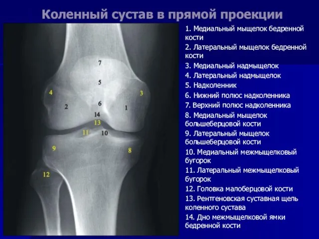 Коленный сустав в прямой проекции 1. Медиальный мыщелок бедренной кости 2. Латеральный