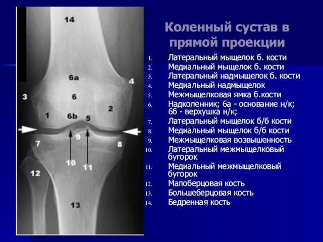 Коленный сустав в прямой проекции Латеральный мыщелок б. кости Медиальный мыщелок б.