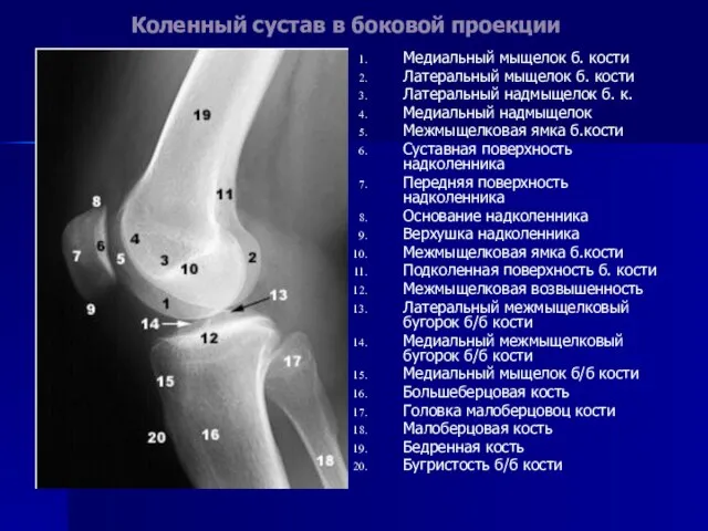 Коленный сустав в боковой проекции Медиальный мыщелок б. кости Латеральный мыщелок б.