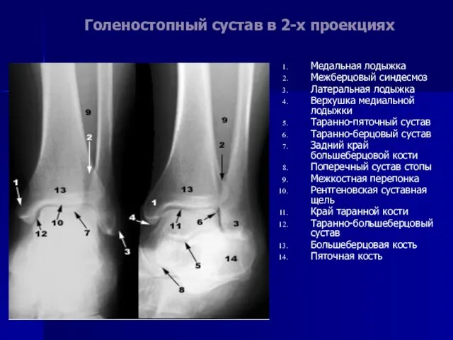 Голеностопный сустав в 2-х проекциях Медальная лодыжка Межберцовый синдесмоз Латеральная лодыжка Верхушка