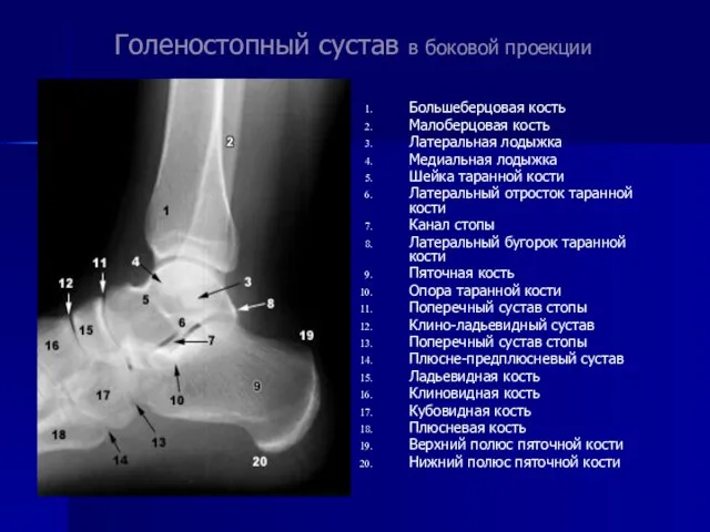 Голеностопный сустав в боковой проекции Большеберцовая кость Малоберцовая кость Латеральная лодыжка Медиальная