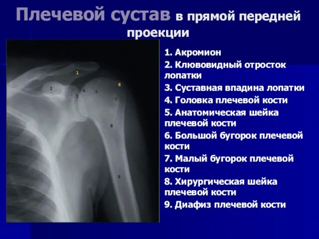 Плечевой сустав в прямой передней проекции 1. Акромион 2. Клювовидный отросток лопатки