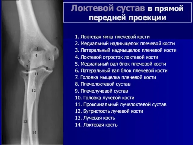 Локтевой сустав в прямой передней проекции 1. Локтевая ямка плечевой кости 2.