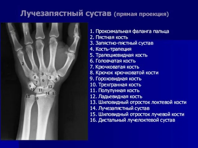 Лучезапястный сустав (прямая проекция) 1. Проксимальная фаланга пальца 2. Пястная кость 3.