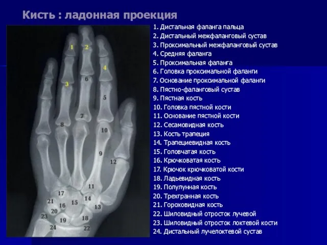 Кисть : ладонная проекция 1. Дистальная фаланга пальца 2. Дистальный межфаланговый сустав