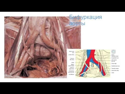 Бифуркация аорты