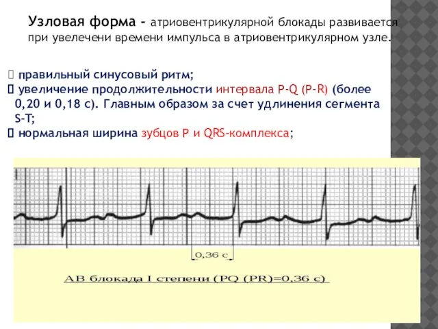 Узловая форма - атриовентрикулярной блокады развивается при увелечени времени импульса в атриовентрикулярном