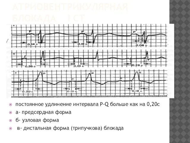 АТРИОВЕНТРИКУЛЯРНАЯ БЛОКАДА I СТ постоянное удлинение интервала P-Q больше как на 0,20с