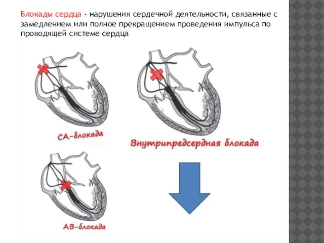 Блокады сердца - нарушения сердечной деятельности, связанные с замедлением или полное прекращением