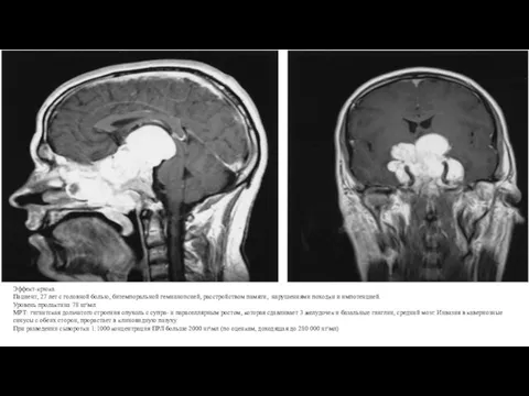 Эффект-крюка Пациент, 27 лет с головной болью, битемпоральной гемианопсией, расстройством памяти, нарушениями