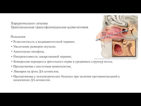 Хирургического лечение Трансназальная транссфеноидальная адемоэктомия Показания: Резистентность к медикаментозной терапии; Увеличение размеров