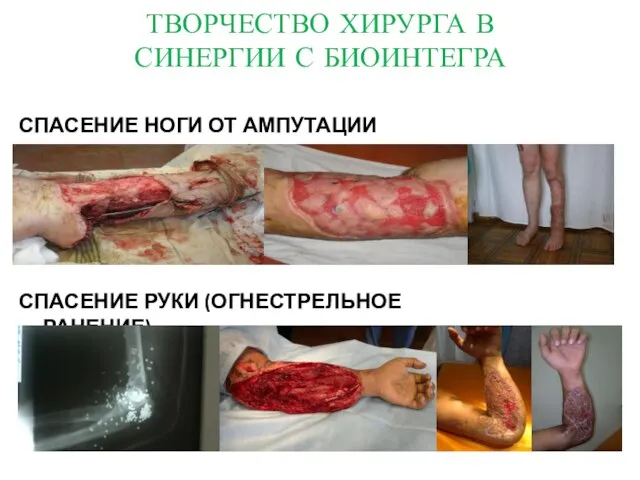 Примеры лечения ран с мазью Биоинтегра ТВОРЧЕСТВО ХИРУРГА В СИНЕРГИИ С БИОИНТЕГРА