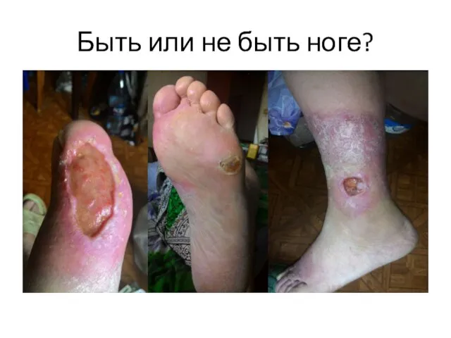 Быть или не быть ноге?