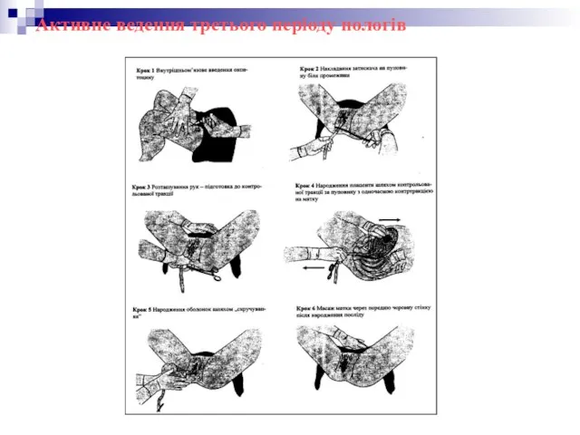 Активне ведення третього періоду пологів