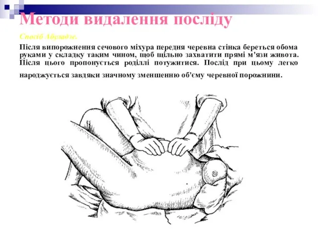 Методи видалення посліду Спосіб Абуладзе. Після випорожнення сечового міхура передня черевна стінка