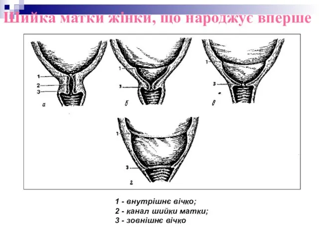 Шийка матки жінки, що народжує вперше 1 - внутрішнє вічко; 2 -