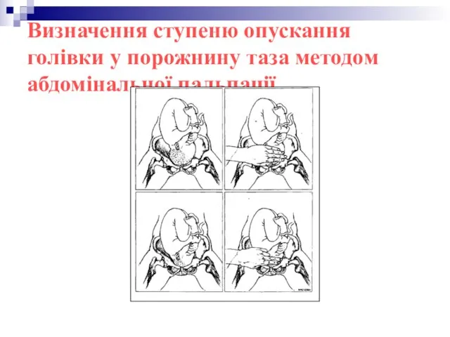 Визначення ступеню опускання голівки у порожнину таза методом абдомінальної пальпації