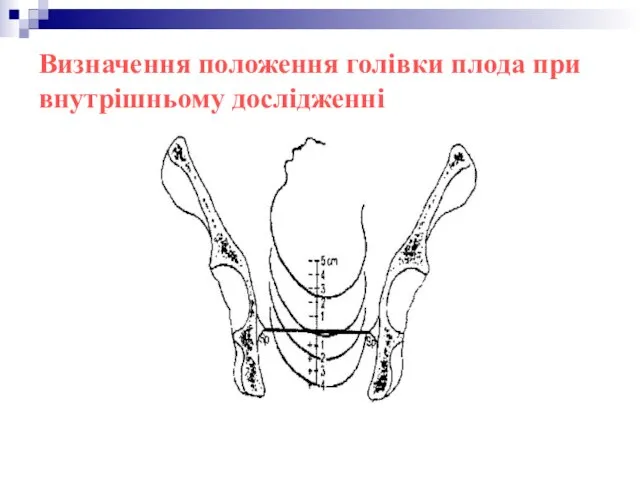 Визначення положення голівки плода при внутрішньому дослідженні