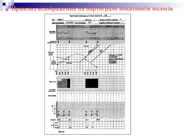 Приклад відображення на партограмі показників пологів