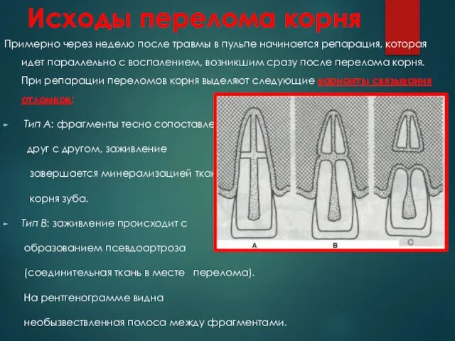 Исходы перелома корня Примерно через неделю после травмы в пульпе начинается репарация,