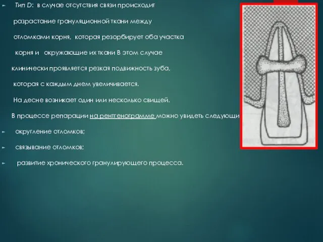 Тип D: в случае отсутствия связи происходит разрастание грануляционной ткани между отломками