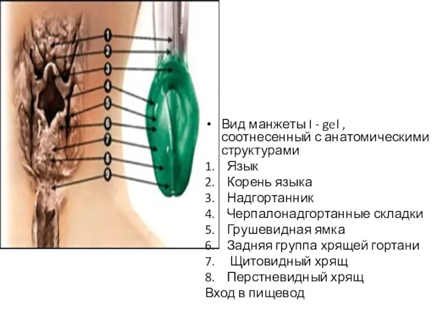 Вид манжеты I - gel , соотнесенный с анатомическими структурами 1. Язык