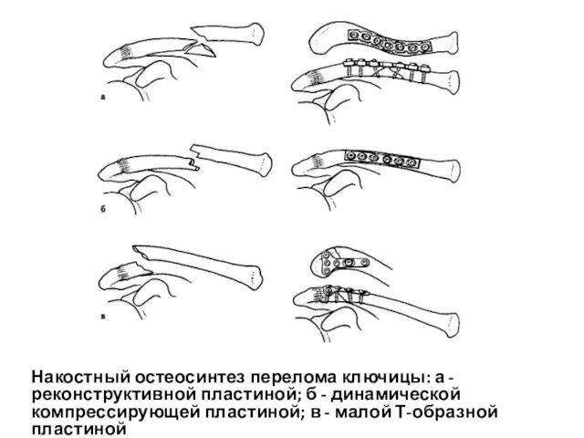 Накостный остеосинтез перелома ключицы: а - реконструктивной пластиной; б - динамической компрессирующей