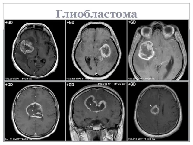 Глиобластома
