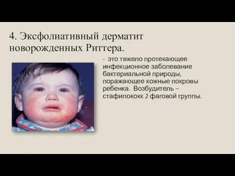 4. Эксфолиативный дерматит новорожденных Риттера. - это тяжело протекающее инфекционное заболевание бактериальной