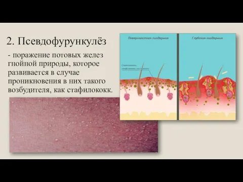 2. Псевдофурункулёз - поражение потовых желез гнойной природы, которое развивается в случае