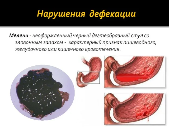 Нарушения дефекации Мелена - неоформленный черный дегтеобразный стул со зловонным запахом -