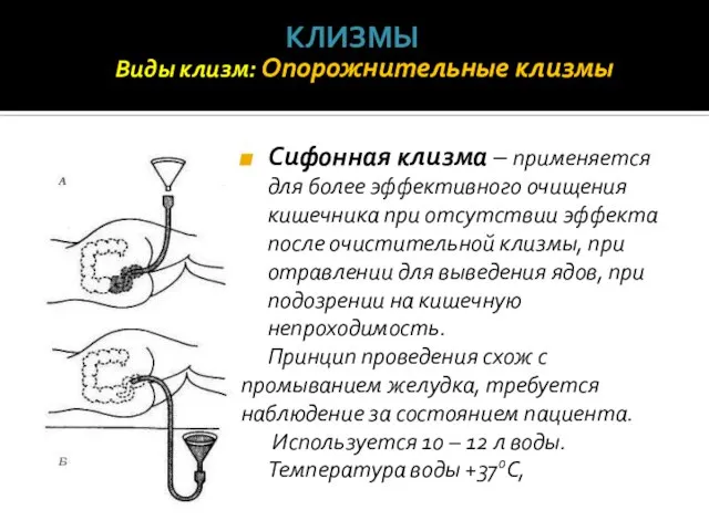 Сифонная клизма – применяется для более эффективного очищения кишечника при отсутствии эффекта