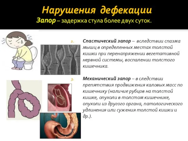 Нарушения дефекации Спастический запор – вследствии спазма мышц в определенных местах толстой