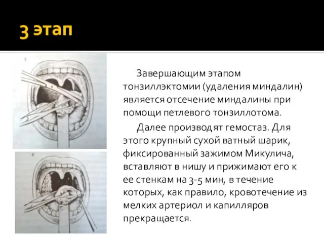 3 этап Завершающим этапом тонзиллэктомии (удаления миндалин) является отсечение миндалины при помощи