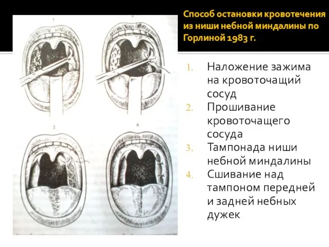 Способ остановки кровотечения из ниши небной миндалины по Горлиной 1983 г. Наложение