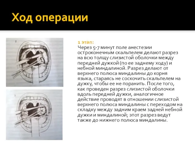 Ход операции 1 этап: Через 5-7 минут поле анестезии остроконечным скальпелем делают