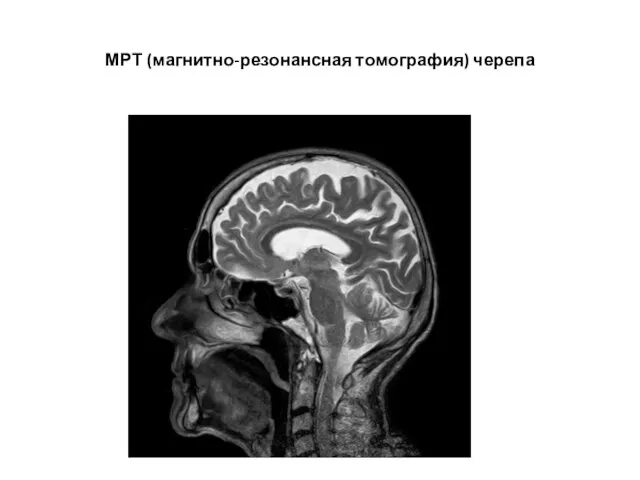 МРТ (магнитно-резонансная томография) черепа