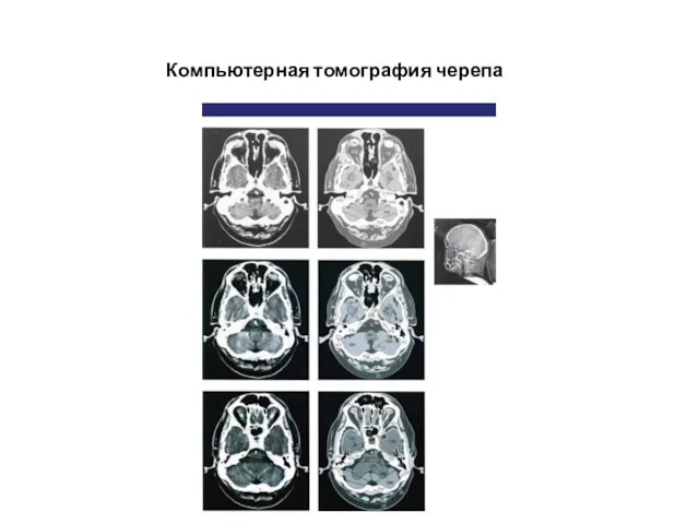 Компьютерная томография черепа